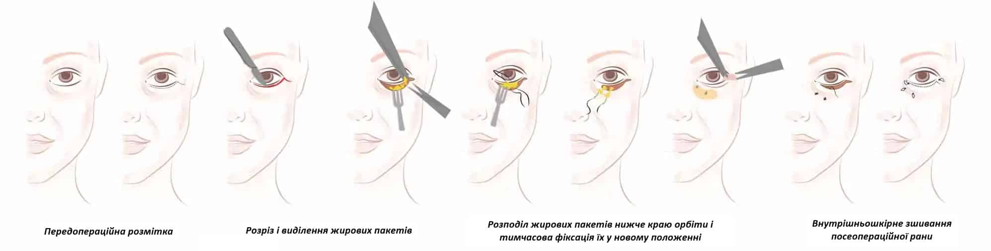 Блефаропластика | Косметология, пластическая и эстетическая хирургия ...